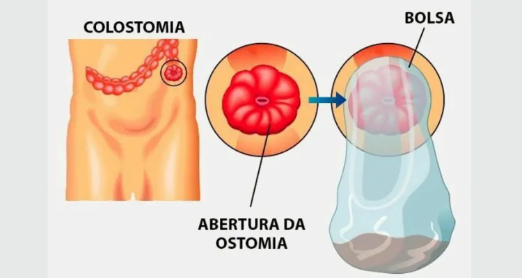 ostomia, colostomia, ileostomia, cuidados com estoma, alimentação saudável.